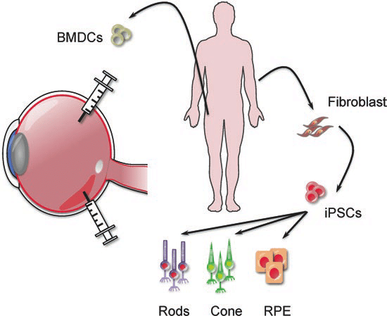 视网膜修复示意图